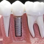 How Do I Fix My Overbite with Clear Aligners?