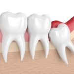 What are the Benefits of Choosing Dentures?