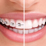 Are Root Canals Painful? The Unfiltered Truth