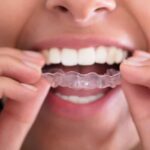 Ways To Straighten Teeth Without Braces