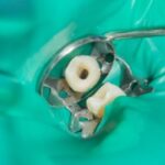 Ways To Straighten Teeth Without Braces