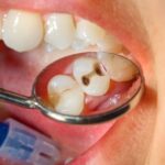 Why Are Porcelain Veneers the Right Option for Dental Restoration?