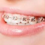 5 Benefits Of Choosing A Dentist Skilled In Restorative Care